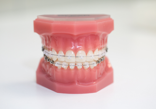 Pros and Cons of Ceramic Braces to Improve Your Smile
